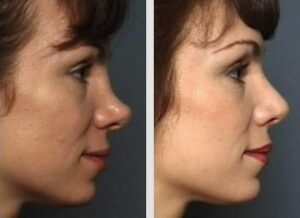 Rhinoplasty Raleigh & Durham, Nc