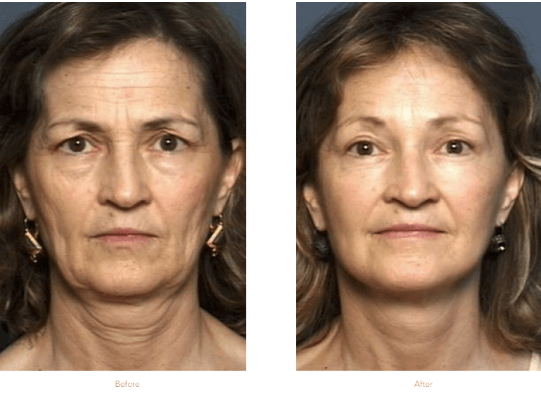 Blepharoplasty Raleigh & Durham, Nc