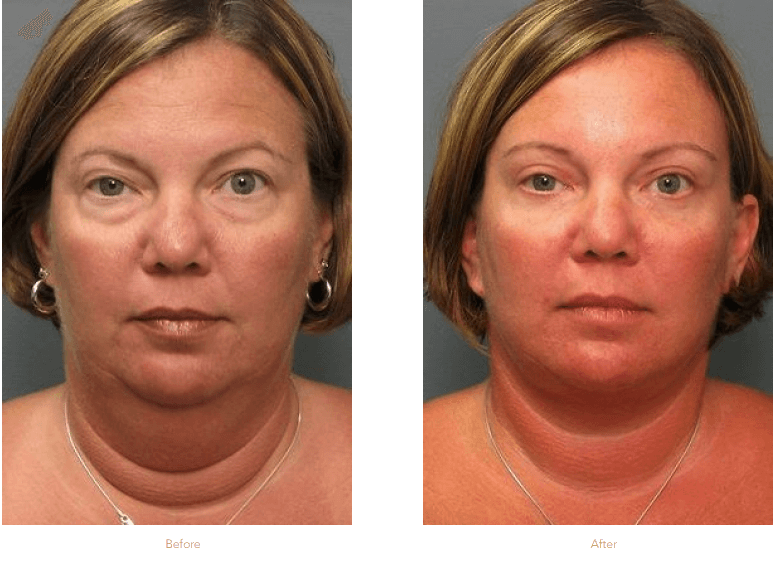 Eyelid Lift Surgery B-a Raleigh & Durham, Nc