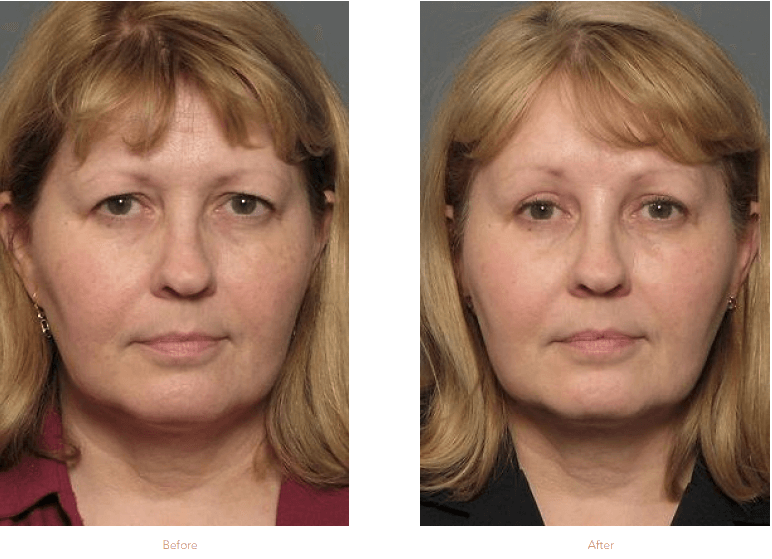 Eyelid Lift Surgery Before & After Raleigh & Durham, NC