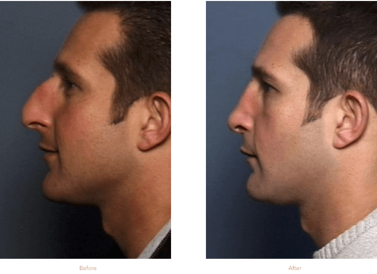 Male Rhinoplasty Raleigh & Durham, NC