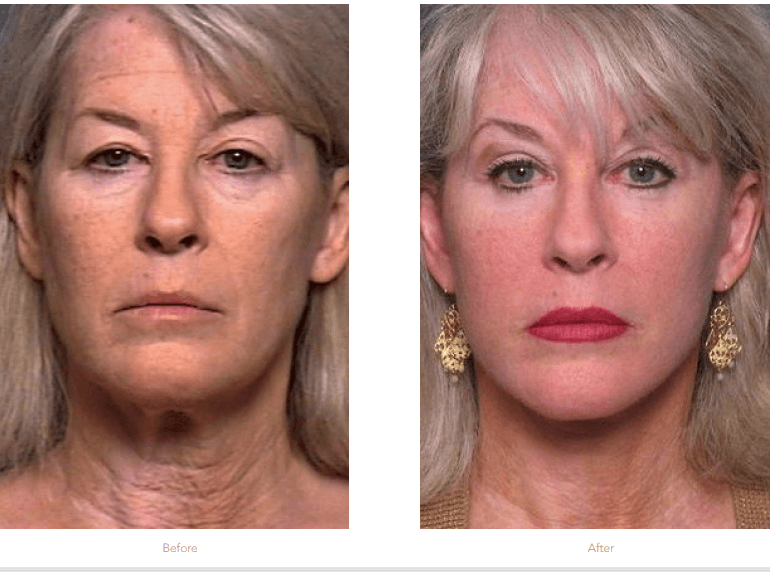 Eyelid Lift Surgery Raleigh & Durham, NC