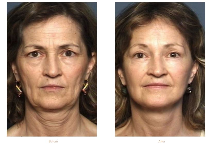Blepharoplasty Before & After Raleigh & Durham, NC