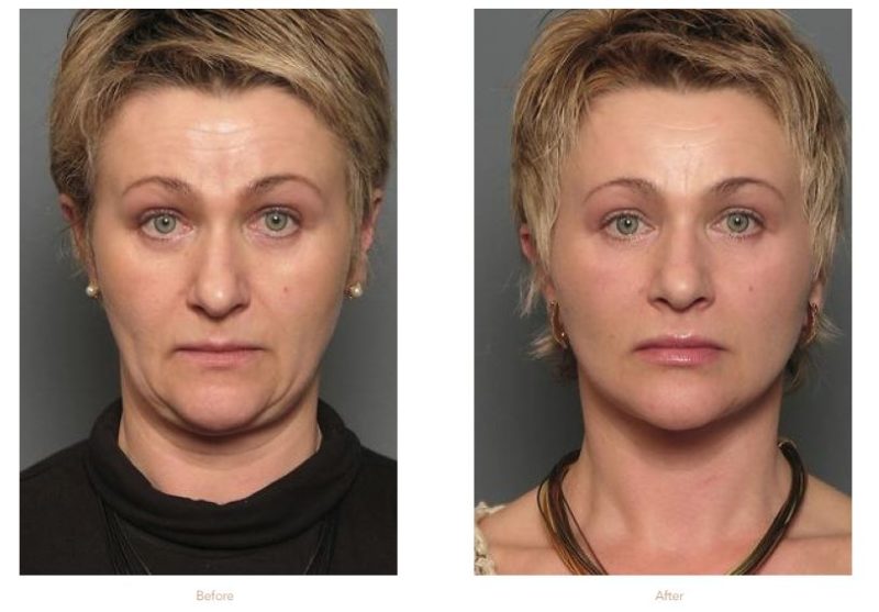 How Can I Lift Sagging Jowls? | Stein Plastic Surgery