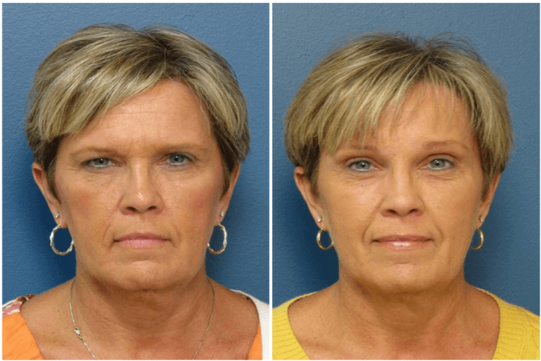 Blepharoplasty Raleigh, NC