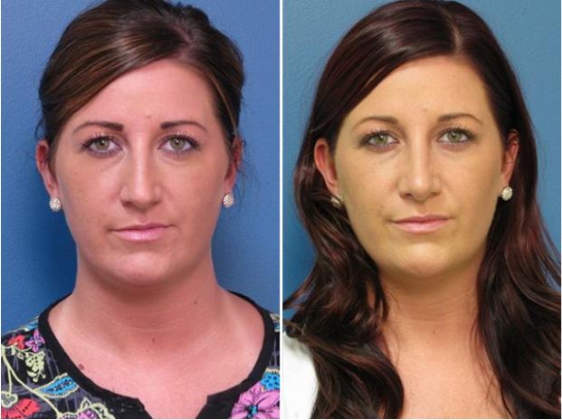 Rhinoplasty Raleigh