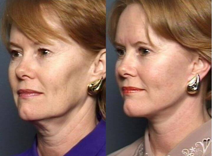 What’s the Best Age for a Facelift? Raleigh Facelift Stein Plastic