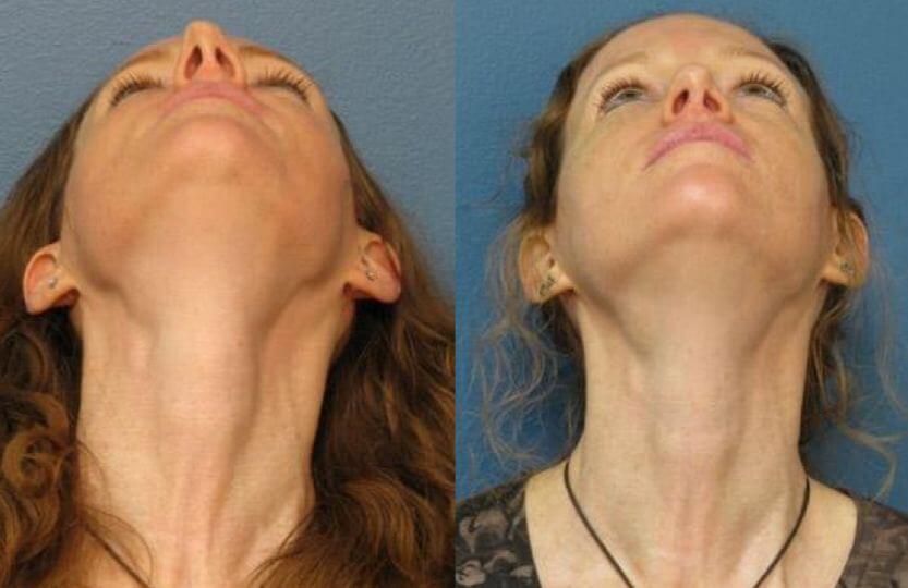 PROCEDURE OF THE WEEK: Nasal Surgery (Rhinoplasty)