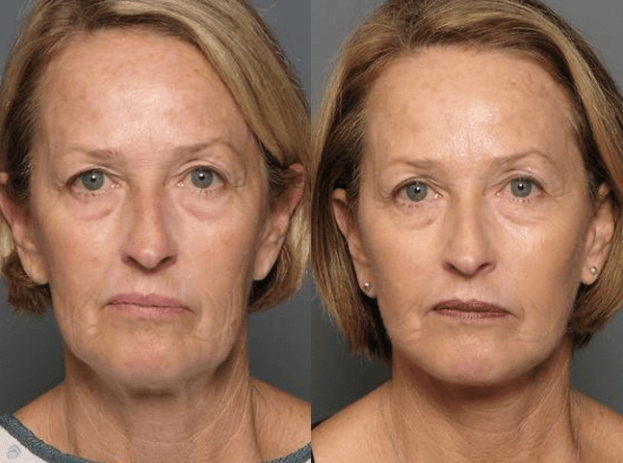 How Much Does A Facelift Cost?, Raleigh Facelift