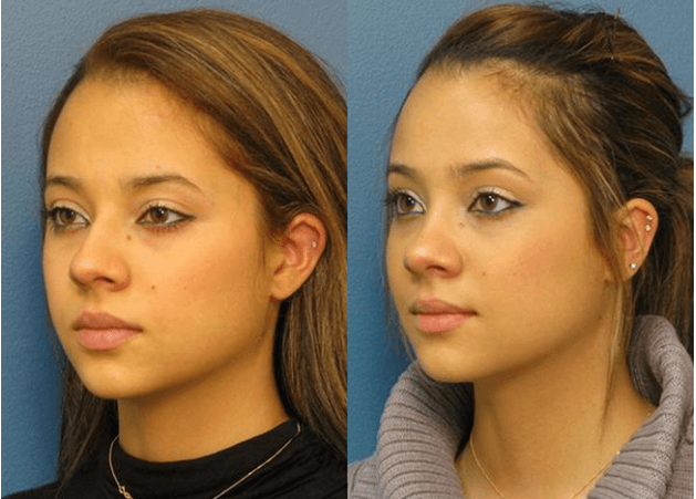 Rhinoplasty