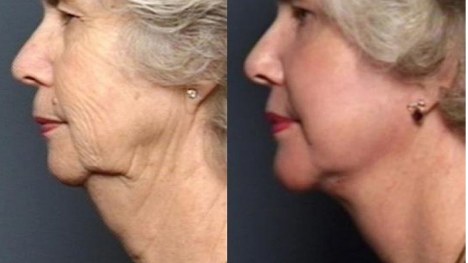 Chin Augmentation Raleigh