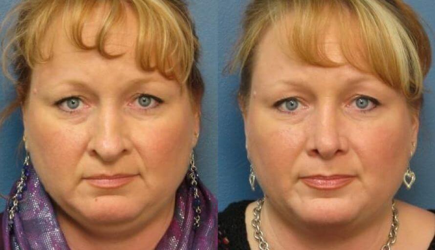 Rhinoplasty Raleigh