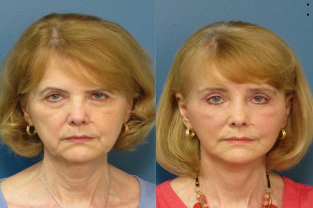 Blepharoplasty Raleigh