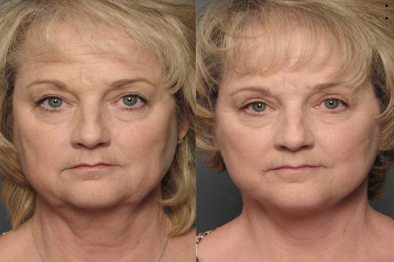 Raleigh Blepharoplasty