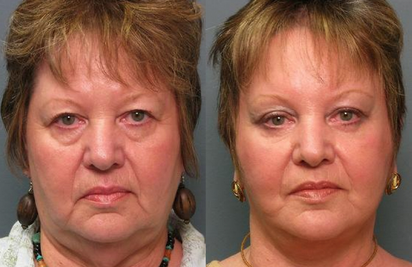 Blepharoplasty Raleigh