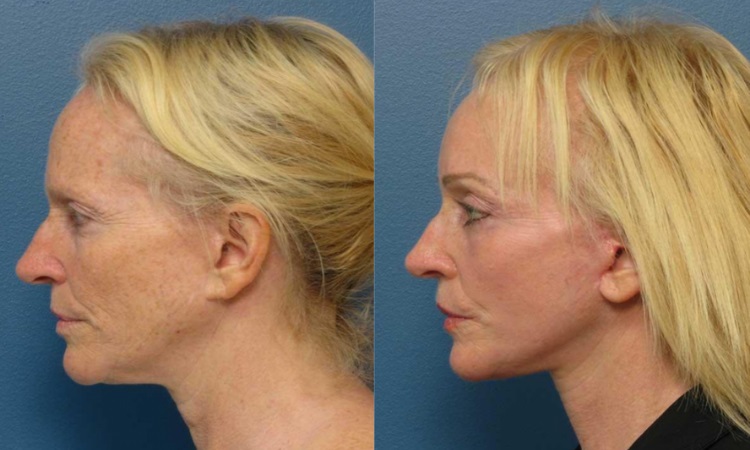 Raleigh Laser Skin Resurfacing