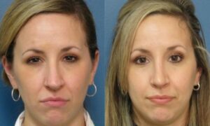 Raleigh Rhinoplasty