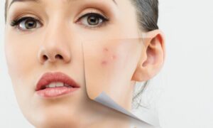 Raleigh Chemical Peels