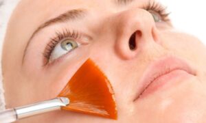 Raleigh Chemical Peels1 Raleigh Chemical Peels