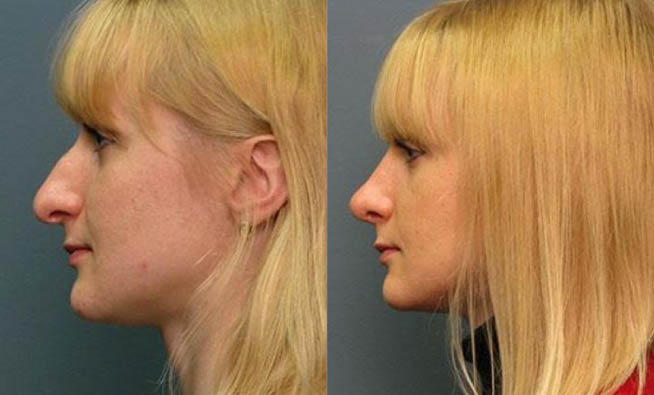 Rhinoplasty Durham & Raleigh