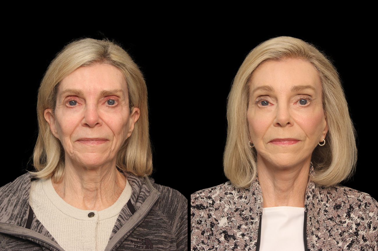 a before and after photo of a woman's face showing her blepharoplasty results in Raleigh, NC