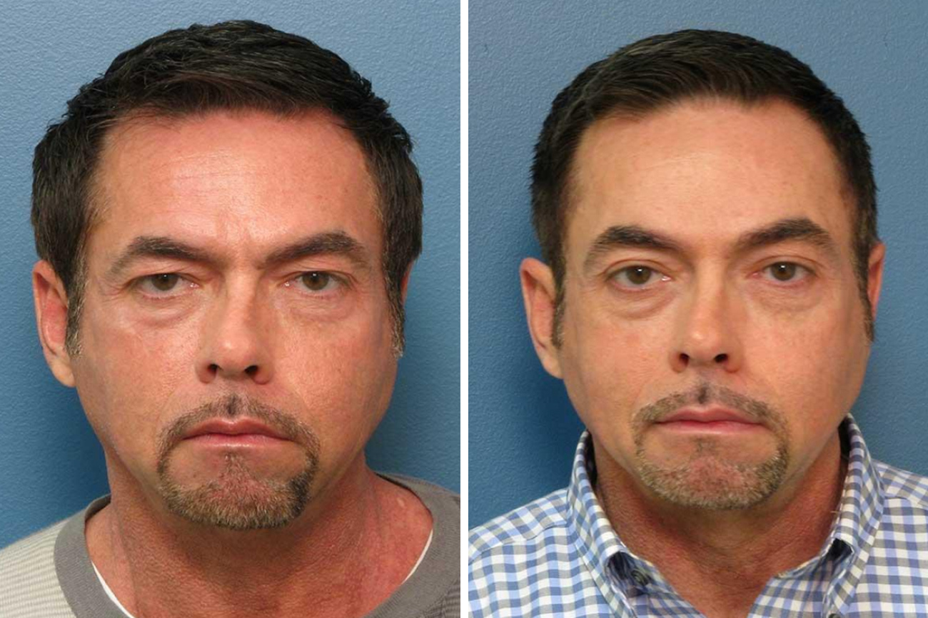 Before and after images of a Raleigh man after upper blepharoplasty surgery.