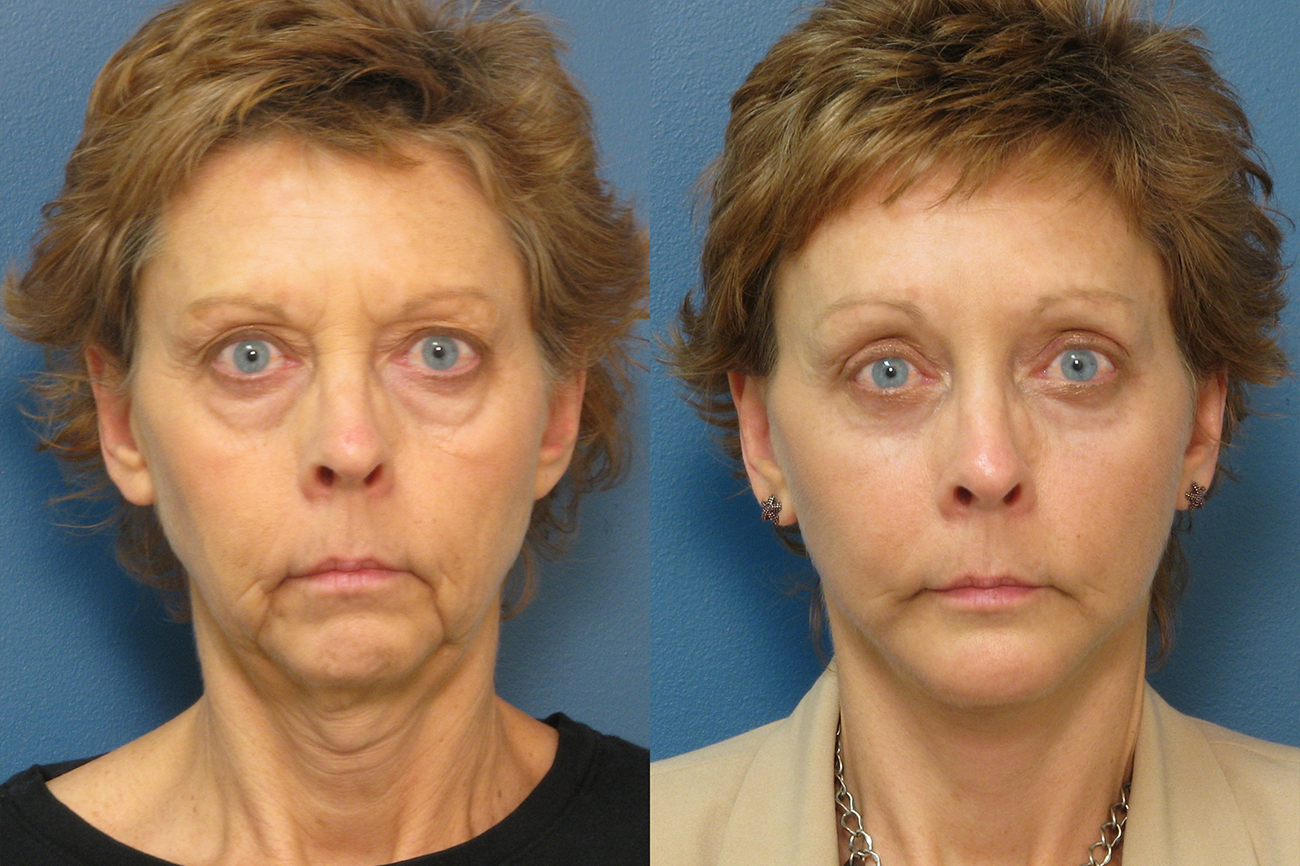 Before and after results of a woman's upper blepharoplasty in Raleigh.