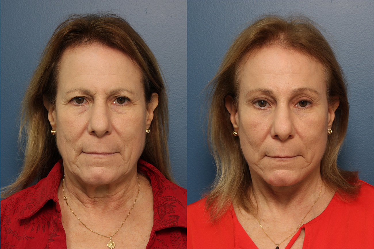 Upper blepharoplasty results of a Raleigh woman.