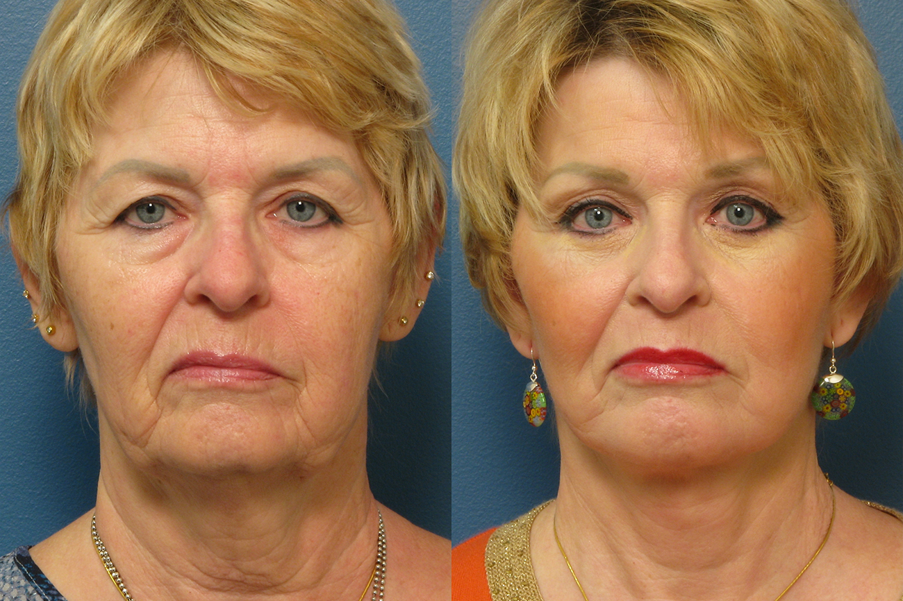 Before and after images of a woman after upper blepharoplasty in Raleigh.