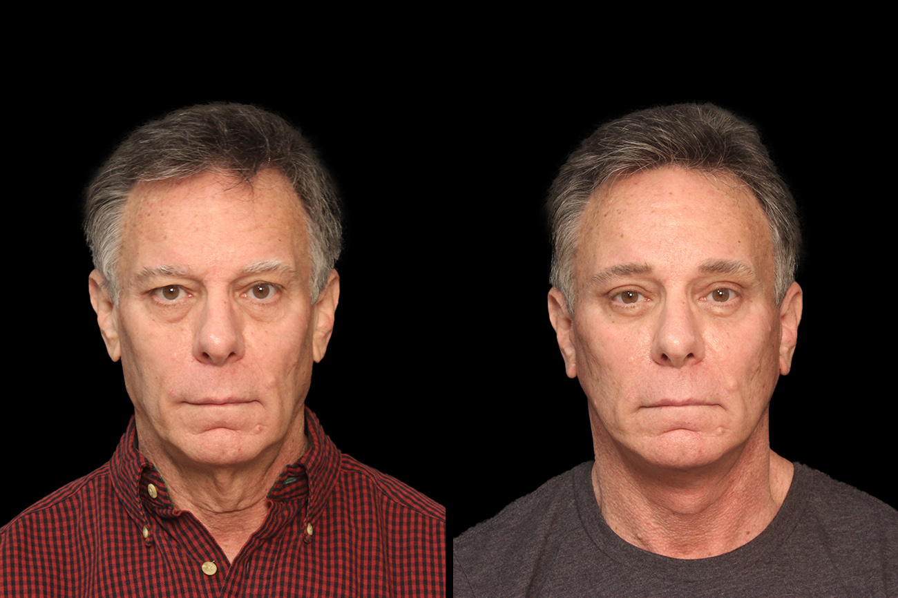 A Raleigh man shows results of his upper blepharoplasty procedure.