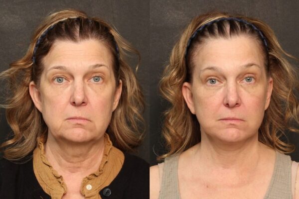 Before and after results of a woman's brow lift in Raleigh.