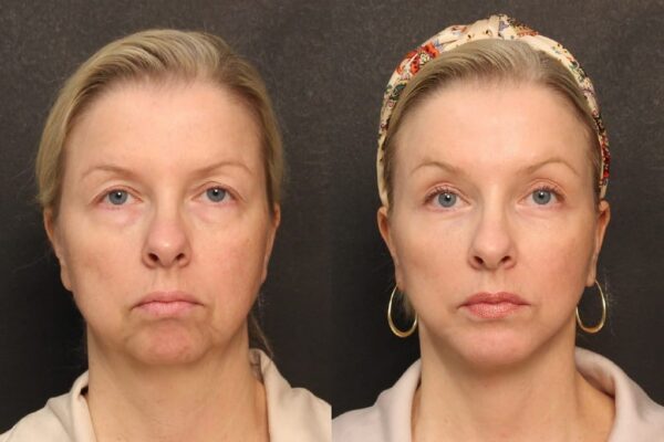 A woman's before and after results of her brow lift in Raleigh at Stein Plastic Surgery.