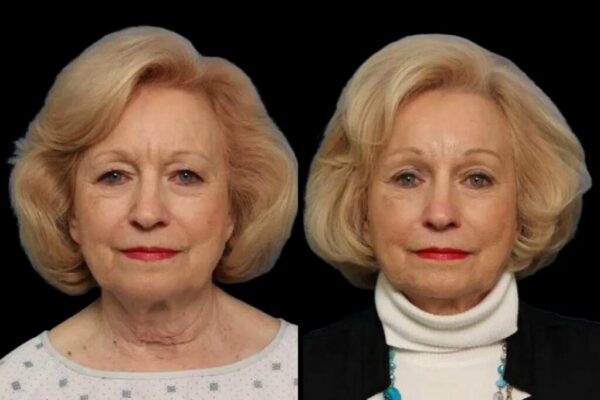 A Raleigh woman's forehead lift results at Stein Plastic Surgery.