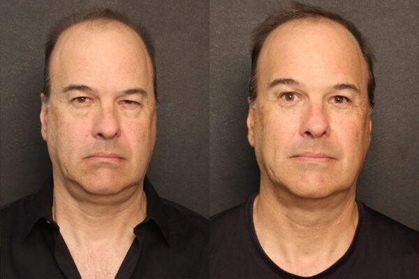 A man's forehead lift before and after results in Raleigh at Stein Plastic Surgery.